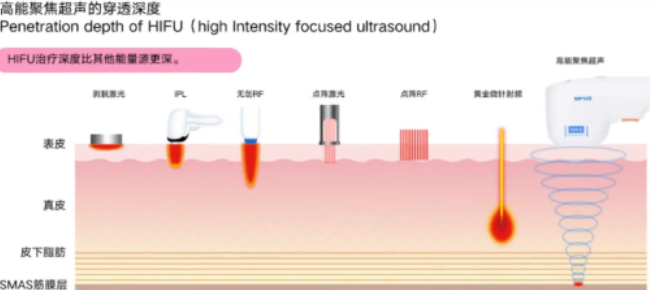 超声炮是什么效果怎么样使用过程痛不痛